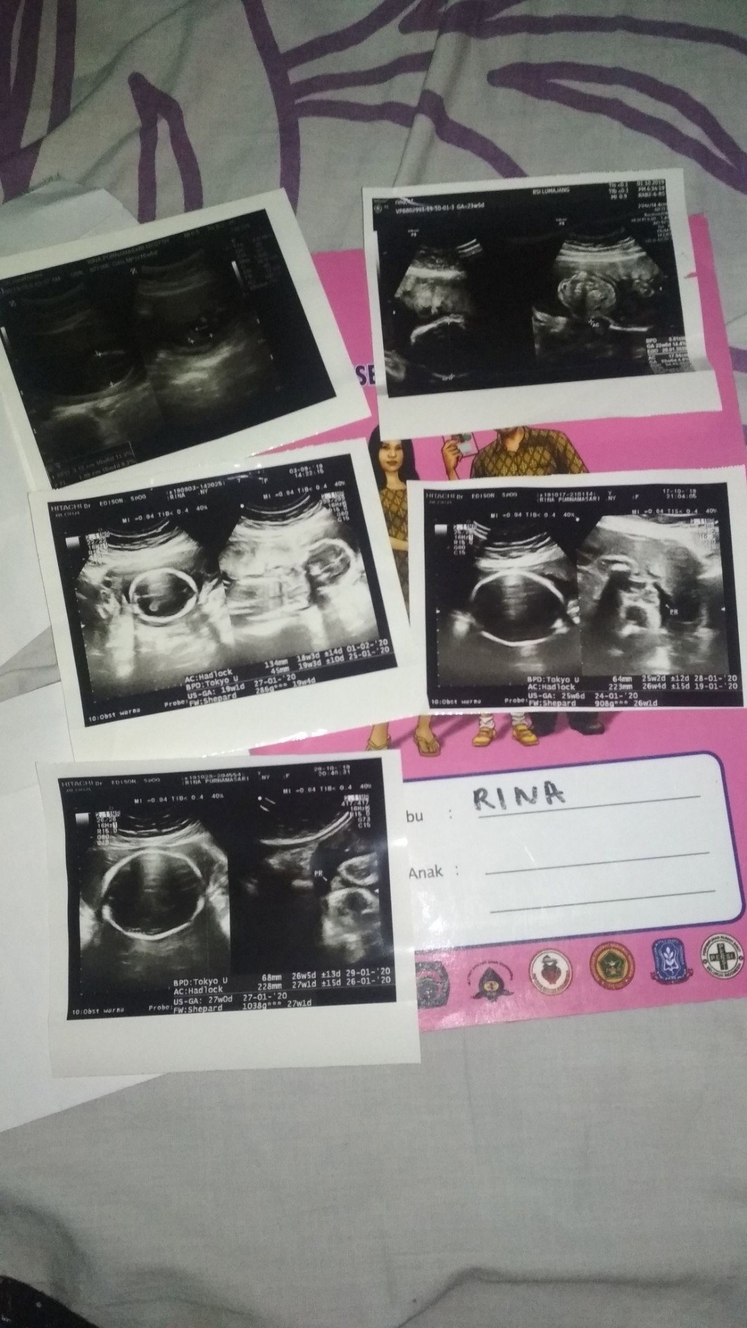 ambeien dikehamilan 27week