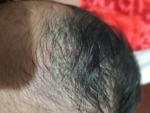 dry skin