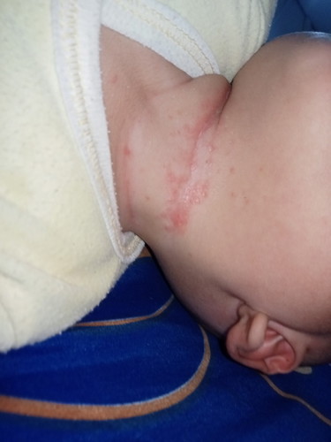 Bund,cara ngatasi merah2 di leher si bocil gimna yaa