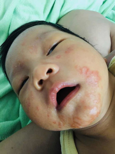 ลูกแพ้อาหารผ่านนมแม่ค่ะ