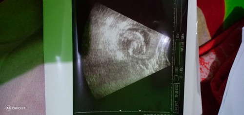 Foto USG tanggal 1 bulan Juli 2019