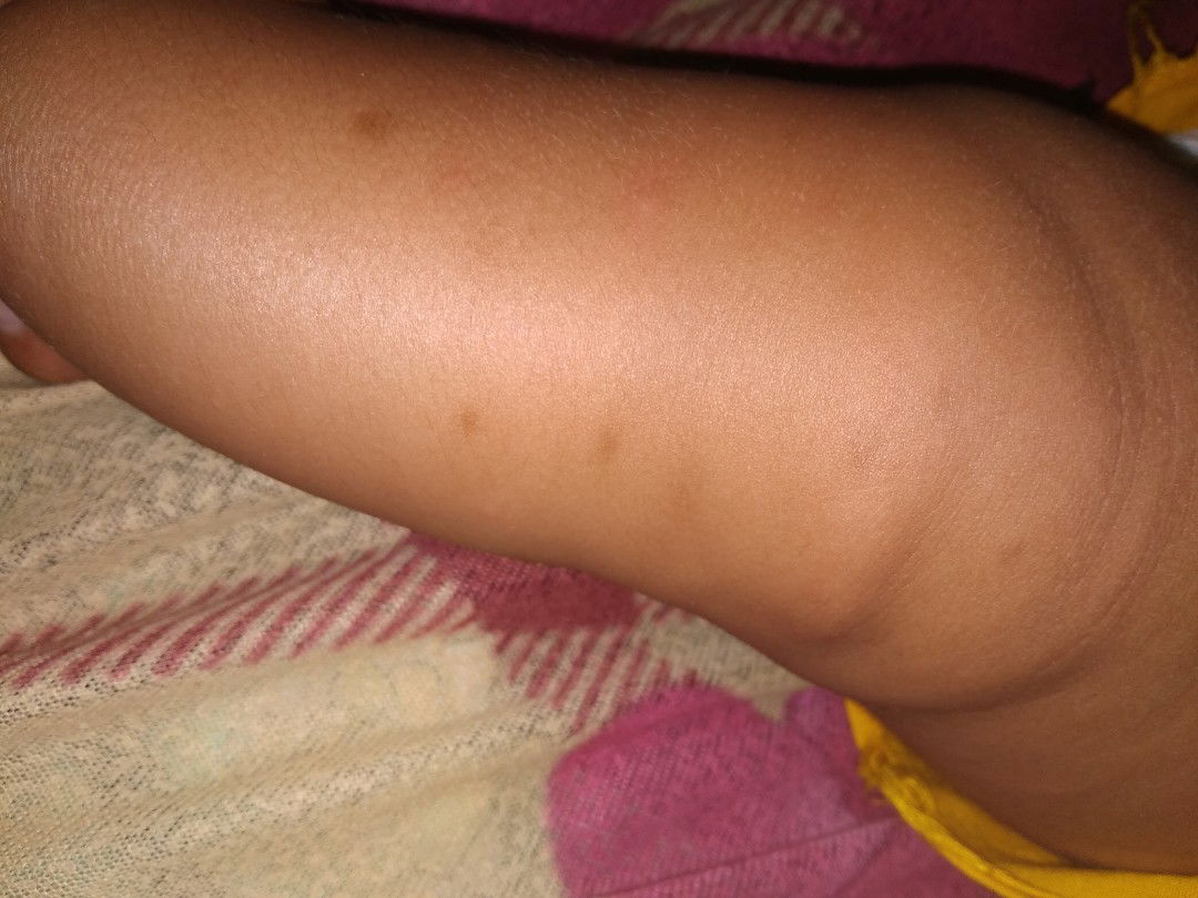 bekas gigitan nyamuk