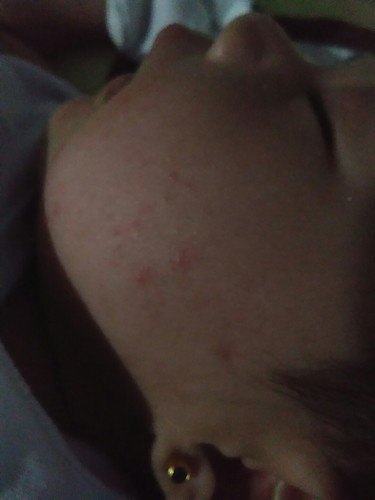 baby rashes