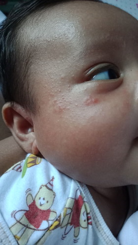 gatal gatal pada pipi baby