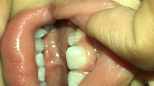 Baby teeth cavity