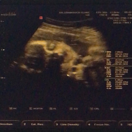 แม่ๆคนไหนเคยกังวลเพราะลูกดิ้นน้อยบ้างคะ?