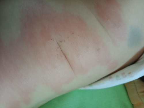 เหมือนโดนตัวอะไรกัดเลยค่ะ เป็นผืนแดงๆ มีรอย