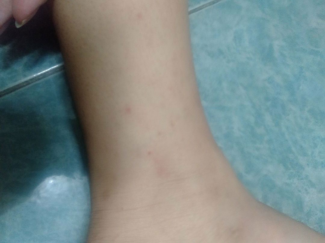 ตุ่มแดง