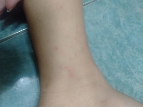 ตุ่มแดง