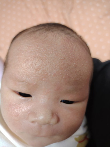 is this baby acne or rash?