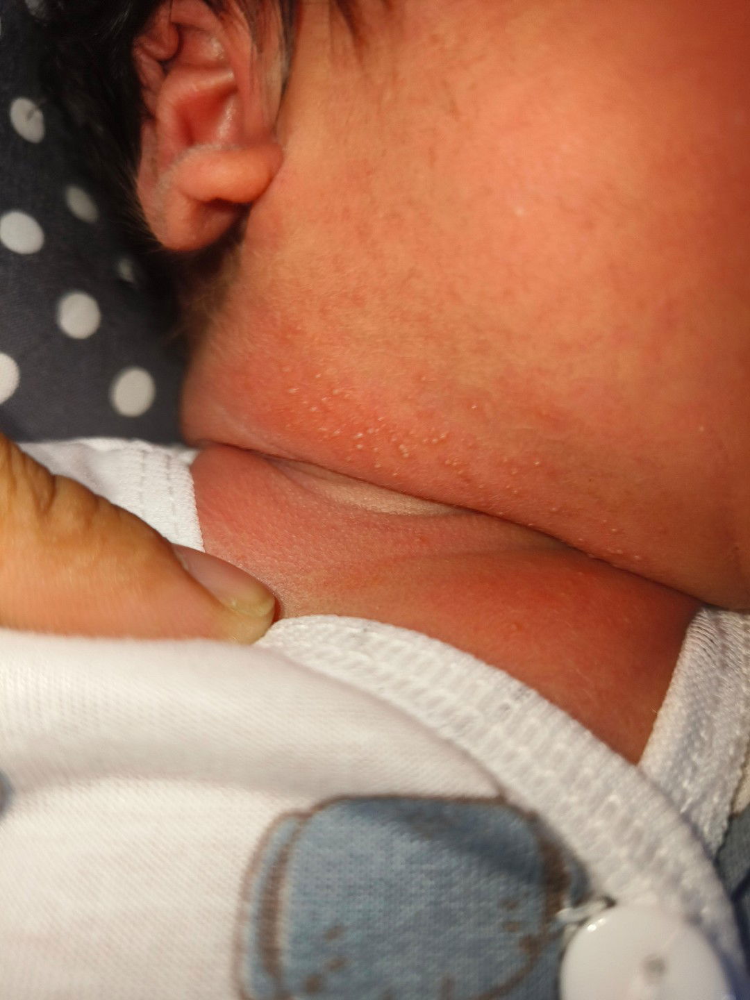 Bayi bruntusan dileher apa obatnya ya bund