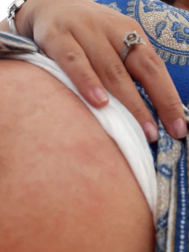 bercak merah pada perut..