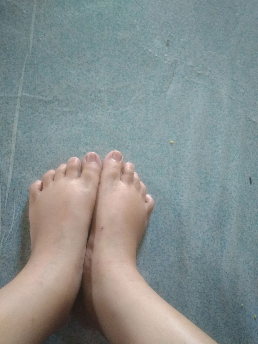 kaki bengkak (hpl januari)