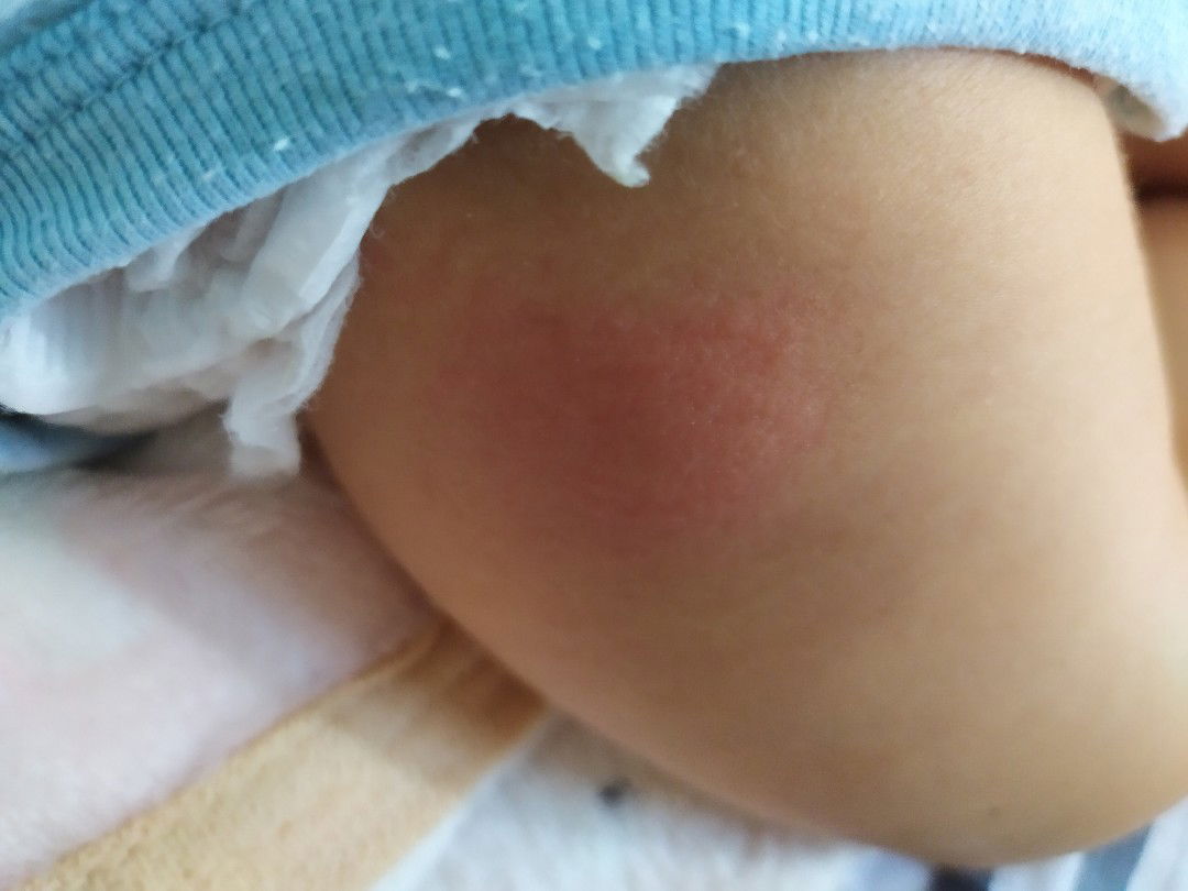 รอยแพ้ยุง