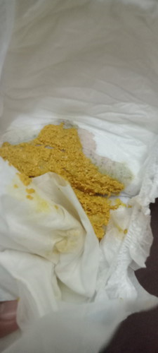 Anak ada g6pd deficiency sy risau najis baby warna MCM nie