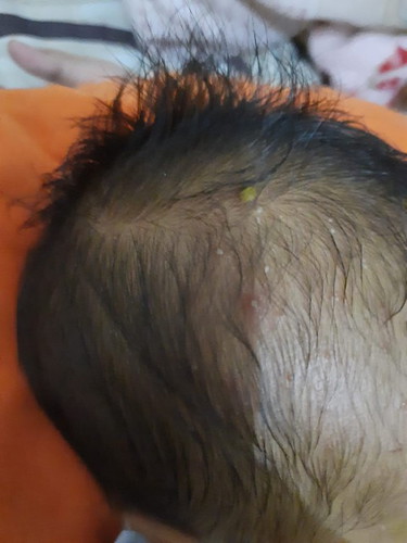 Kepala bayi seperti ada jerawat