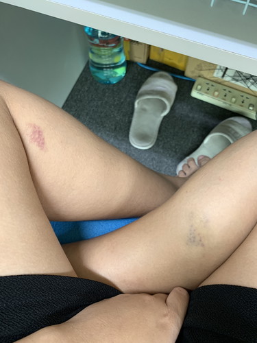 ตั้งครรภ์ 21 weeks ขามีรอยช้ำ