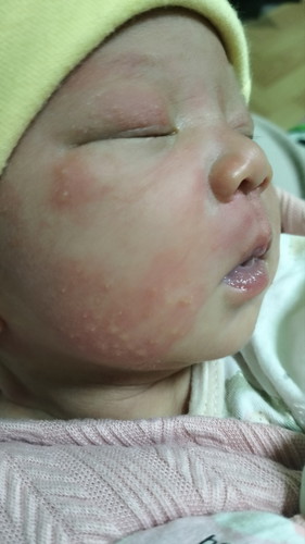 ผื่นขึ้นบริเวณใบหน้าลูก