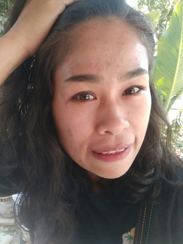 มาแชร์ประสปการหน้าพังตอนตั้งครรภ์