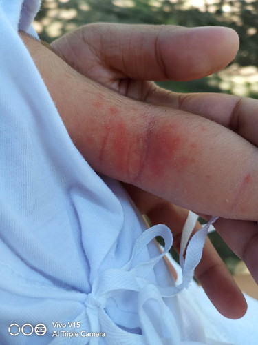 Rashes