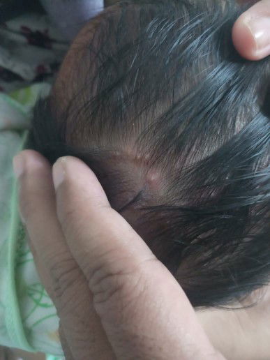 Bintik bernanah di kepala