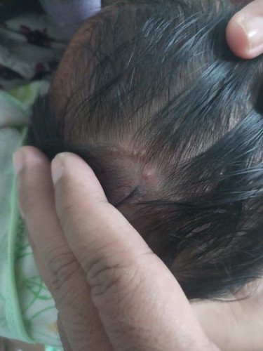 Bintik bernanah di kepala