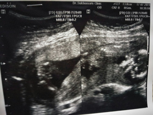 ซาวหน้าท้อง 16 สัปดาห์ หมอบอกว่าน่าจะผู้ชาย