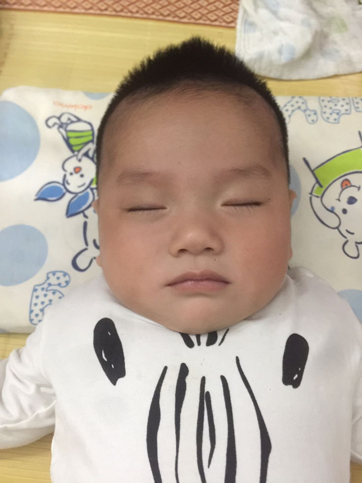 Các mom cho e hỏi với ạ . 2 ngày gần đây má của bé nhà e có hơi đỏ và đến ngày hôm nay thì tự nhiên má và vùng quanh miệng có sự khác biệt về da rõ