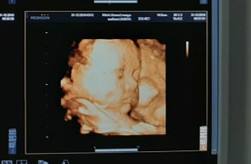 Jenis kelamin berdasarkan USG