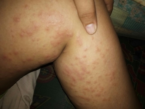 PUPPP RASH