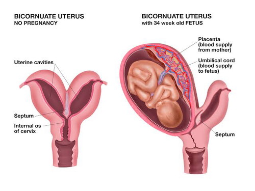 Bicornuate Uterus