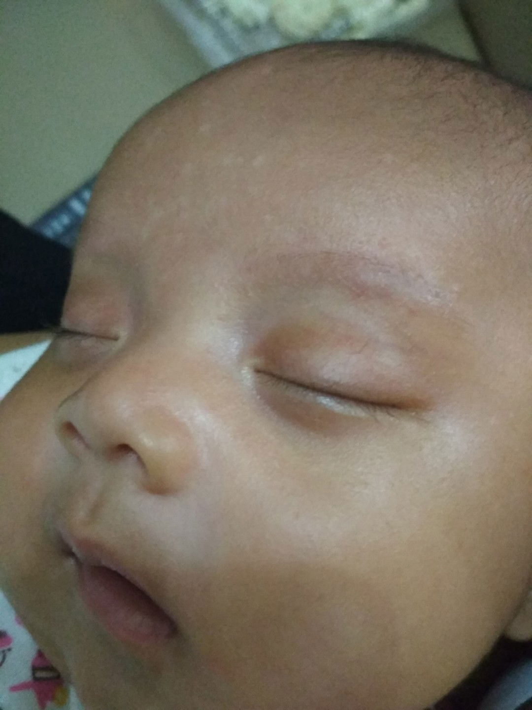 bintik atau bercak putih pada wajah