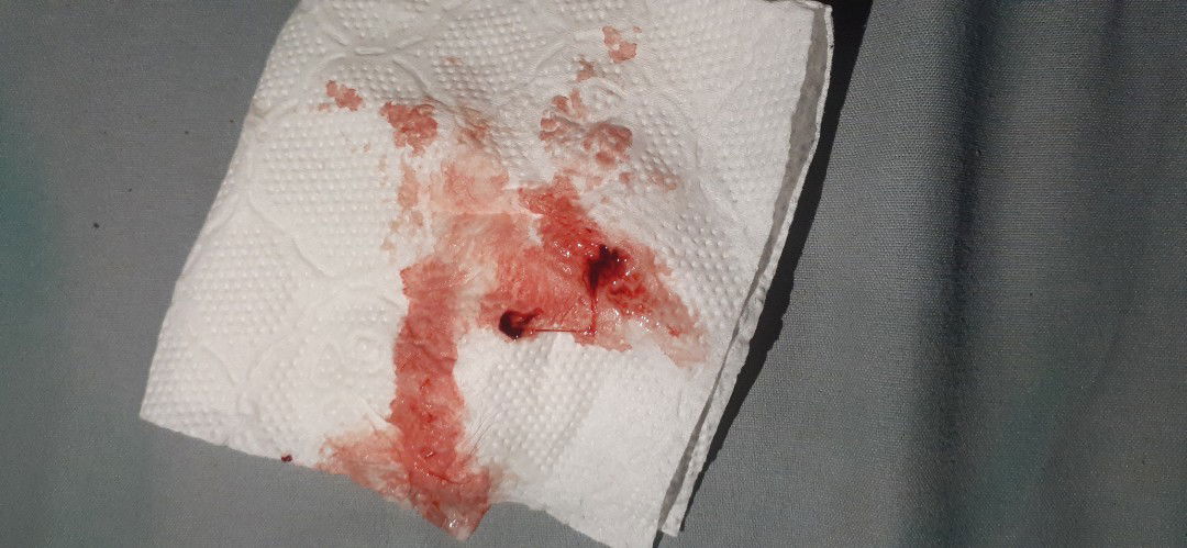 มูกเลือดแบบนี้ควรไปหาหมอมั้ยคะ