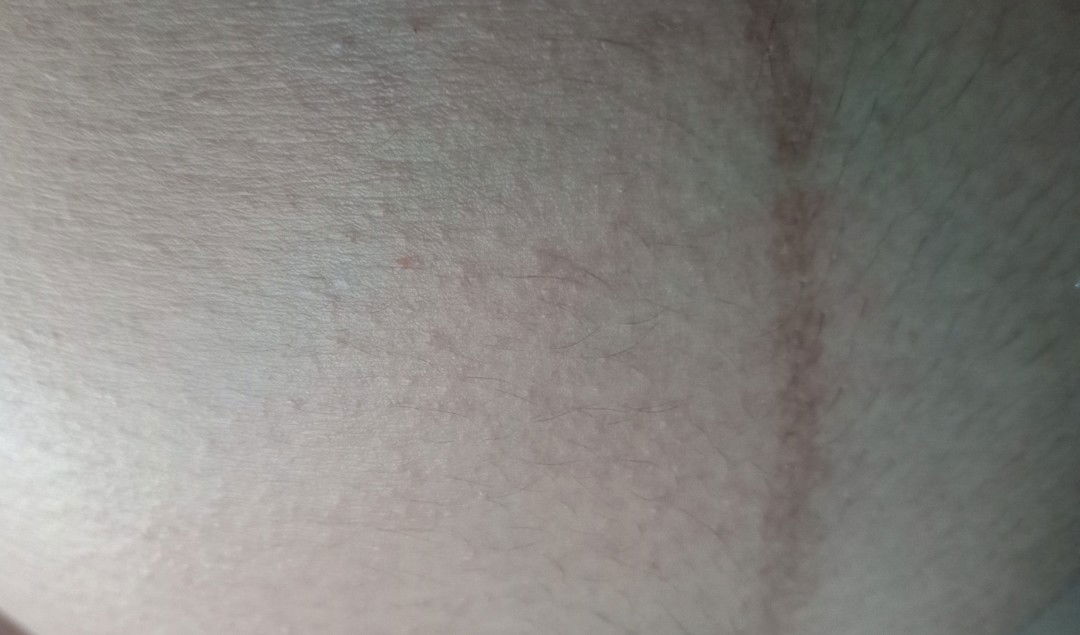 perut dan payudara gatal2