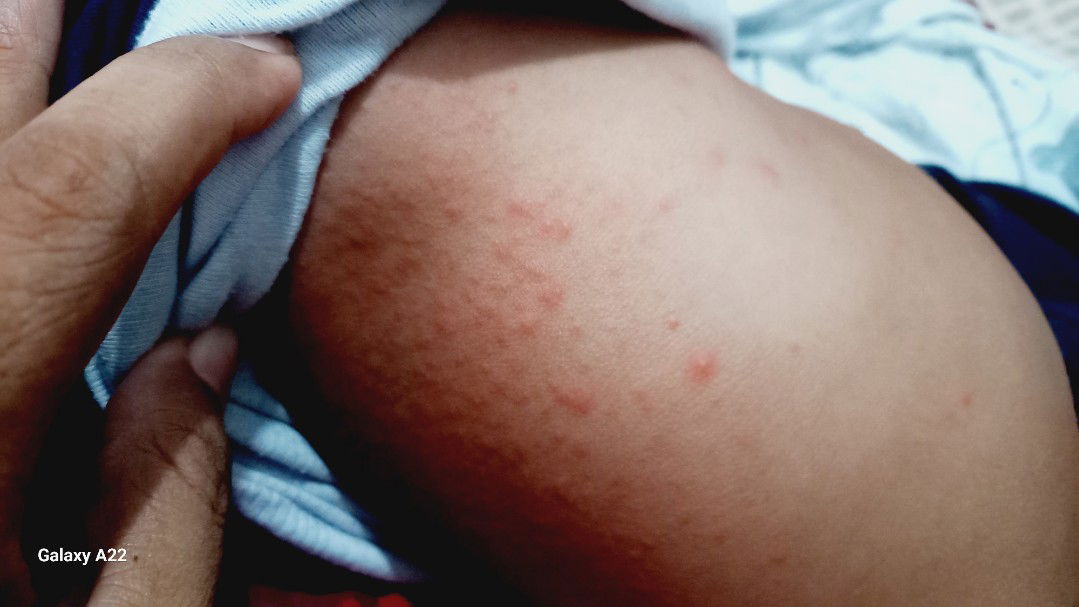 Anak keluar bintik², share pengalaman dikasih apa ya agar bisa berkurang dan hilang.