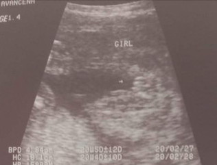 Possible po ba magbago pa ang gender sa Ultrasound? 20weeks