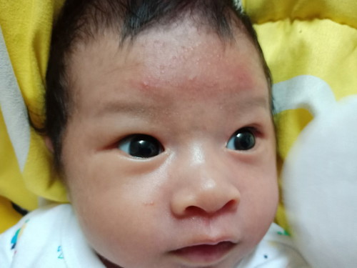 ผดผื่นลูก