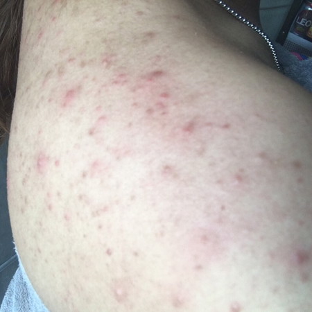 บ้านไหนสิวขึ้นแบบนี้บ้าง