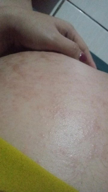 Hamil 8bulan ga kuat gatel bgt perut🥹