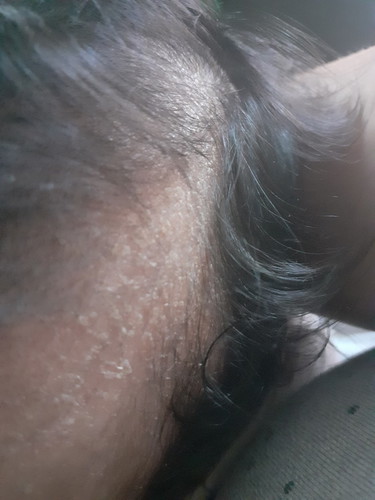 dandruff