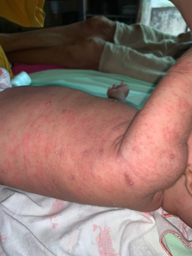 Bun saranny dong , anak saya umur 2 bulan keluar bintik2 merah, sudh 3x berobat gk ad perubahan
