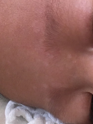 white spots