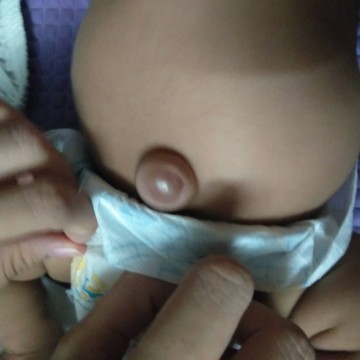 Hernia