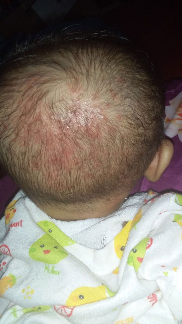 BINTIK MERAH SEDIKIT BERNANAH