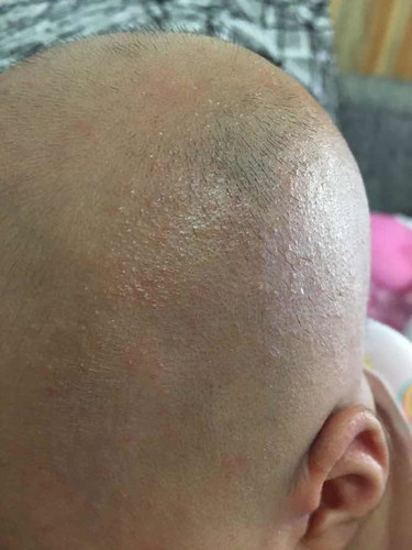 ลูกเป็นผื่นที่หน้า หัว หู ตอนน้องเกิดได้25วัน เป็นมา2อาทิตแล้วยังไม่หายเลย เป็นๆหายๆ น้องกินนมแม่และกินนมเสริมเอนฟาแล็กตั้งแต่น้องเกิดได้1อาทิต ไม่รู้จะทำอย่างไรตุ่มถึงจะหาย ทาอะไรดี