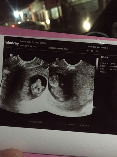 Janin kembar, satu di vonis cacat