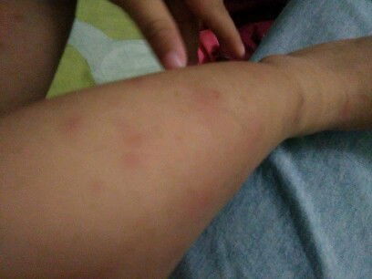 gatal alergi pada anak