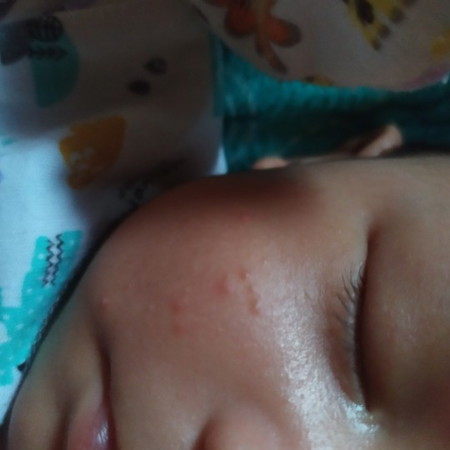 Jerawat Bayi ?
