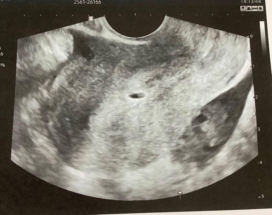 แท้ง 6 วีค ไม่มีสัญญาณเตือนอะไรเลยค่ะ