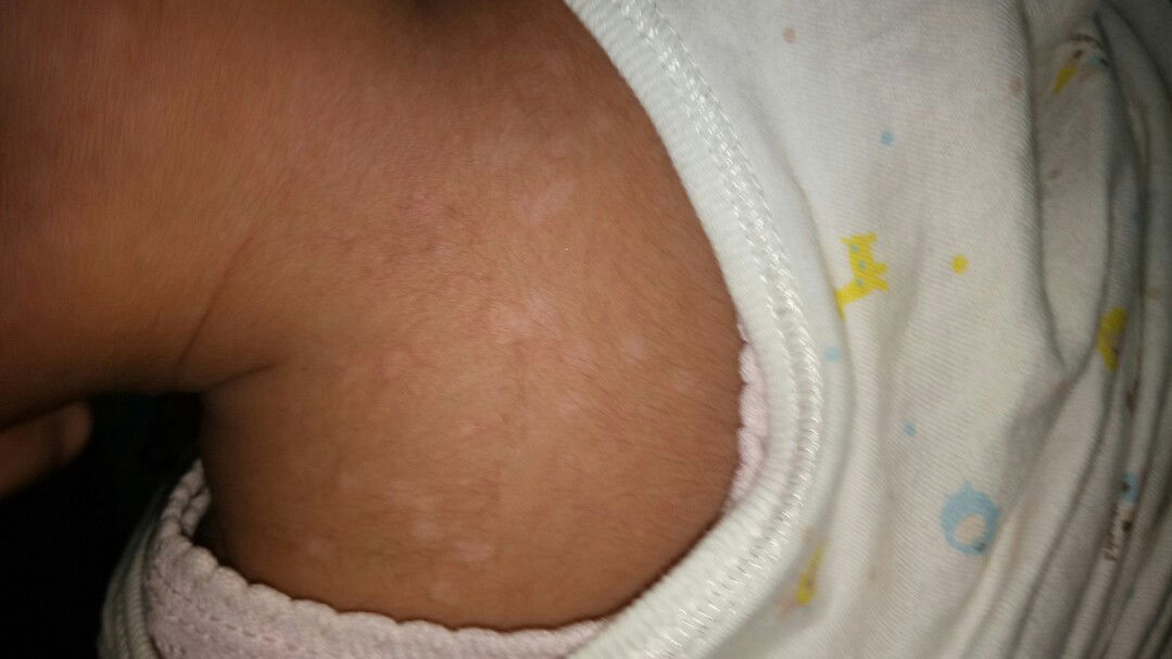 kulit bayi bintik putih